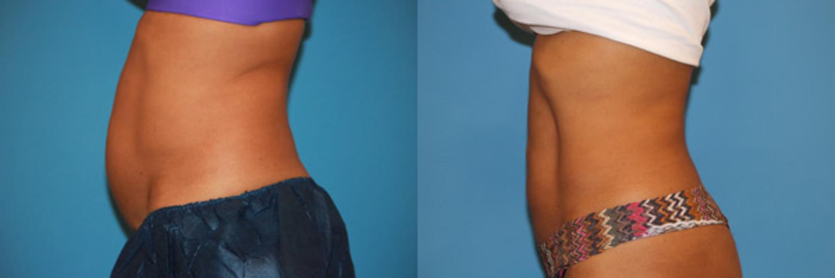 Before & After CoolSculpting® Case 60 View #2 View in Atlanta, Georgia