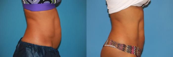Before & After CoolSculpting® Case 60 View #3 View in Atlanta, Georgia