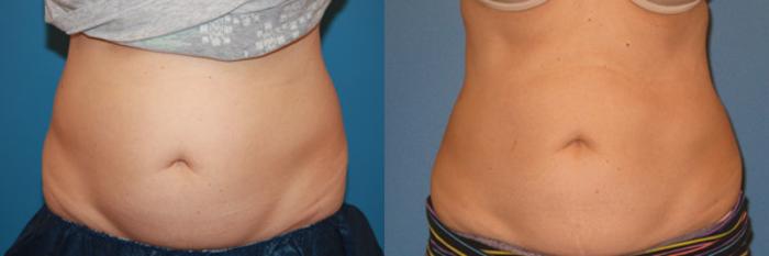 Before & After CoolSculpting® Case 61 View #1 View in Atlanta, Georgia