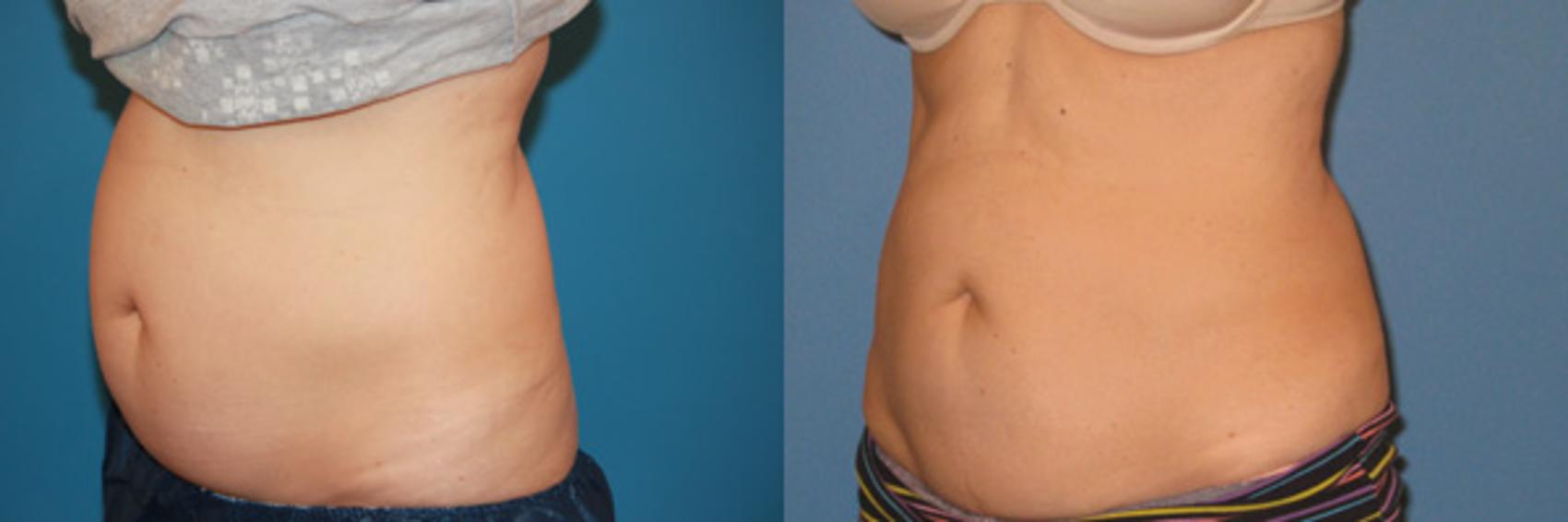 Before & After CoolSculpting® Case 61 View #2 View in Atlanta, Georgia