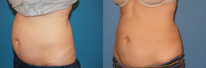 Before & After CoolSculpting® Case 61 View #2 View in Atlanta, Georgia