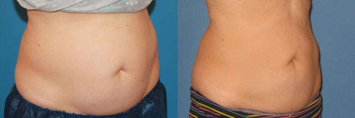 Before & After CoolSculpting® Case 61 View #3 View in Atlanta, Georgia
