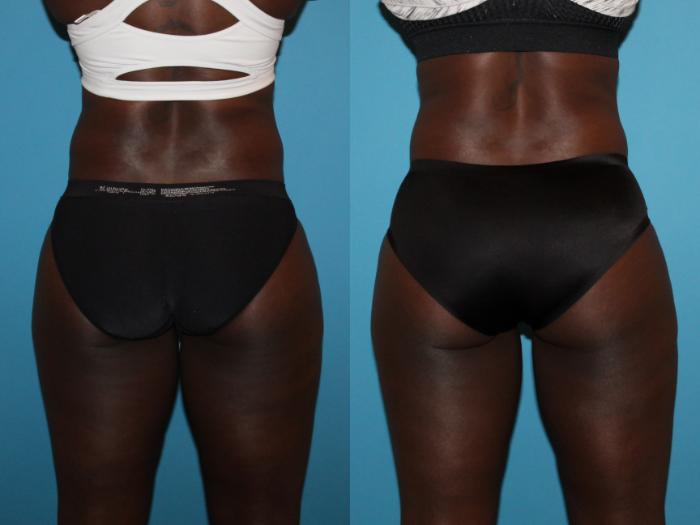 Before & After CoolSculpting® Case 93 View #1 View in Atlanta, Georgia