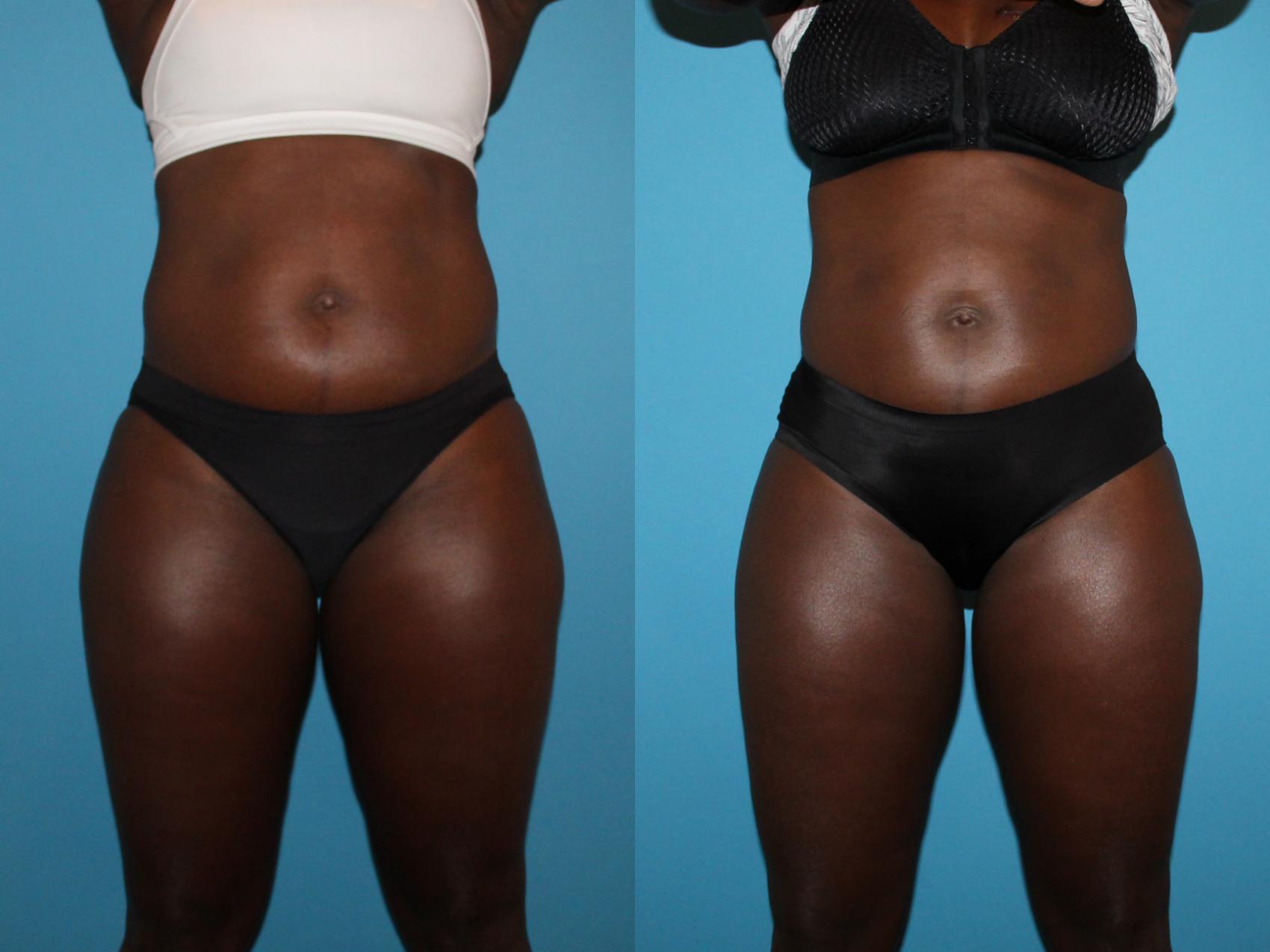 Before & After CoolSculpting® Case 93 View #2 View in Atlanta, Georgia