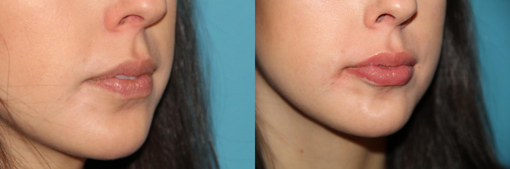 Before & After Dermal Fillers Case 116 View #1 View in Atlanta, Georgia