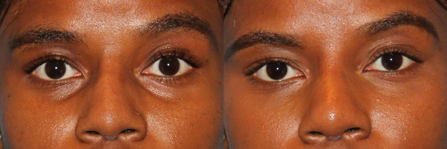 Before & After Dermal Fillers Case 117 View #1 View in Atlanta, Georgia