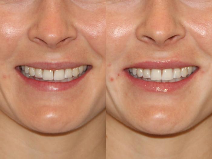 Before & After Dermal Fillers Case 124 View #1 View in Atlanta, Georgia