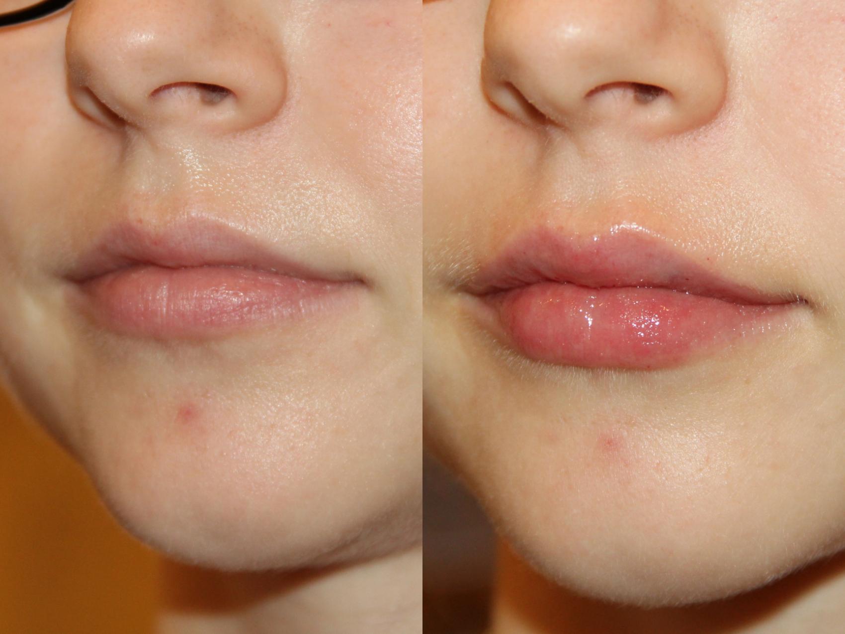 Before & After Dermal Fillers Case 127 View #1 View in Atlanta, Georgia