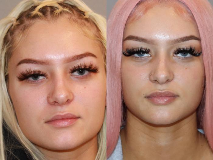 Before & After Dermal Fillers Case 148 Front View in Atlanta, Georgia