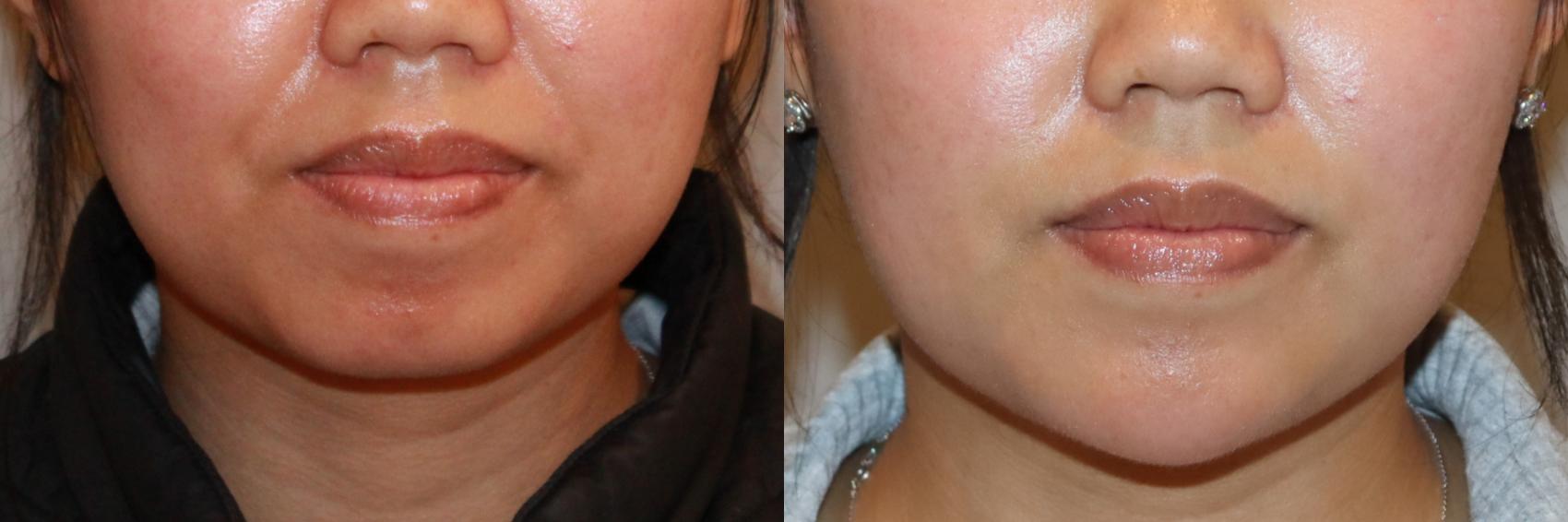 Before & After Dermal Fillers Case 156 Front View in Atlanta, Georgia