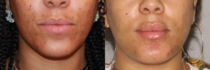 Before & After Dermal Fillers Case 171 Front View in Atlanta, Georgia