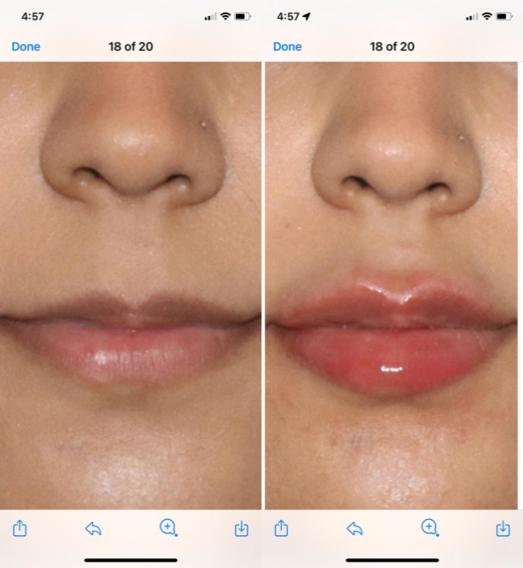Before & After Dermal Fillers Case 172 Front View in Atlanta, Georgia