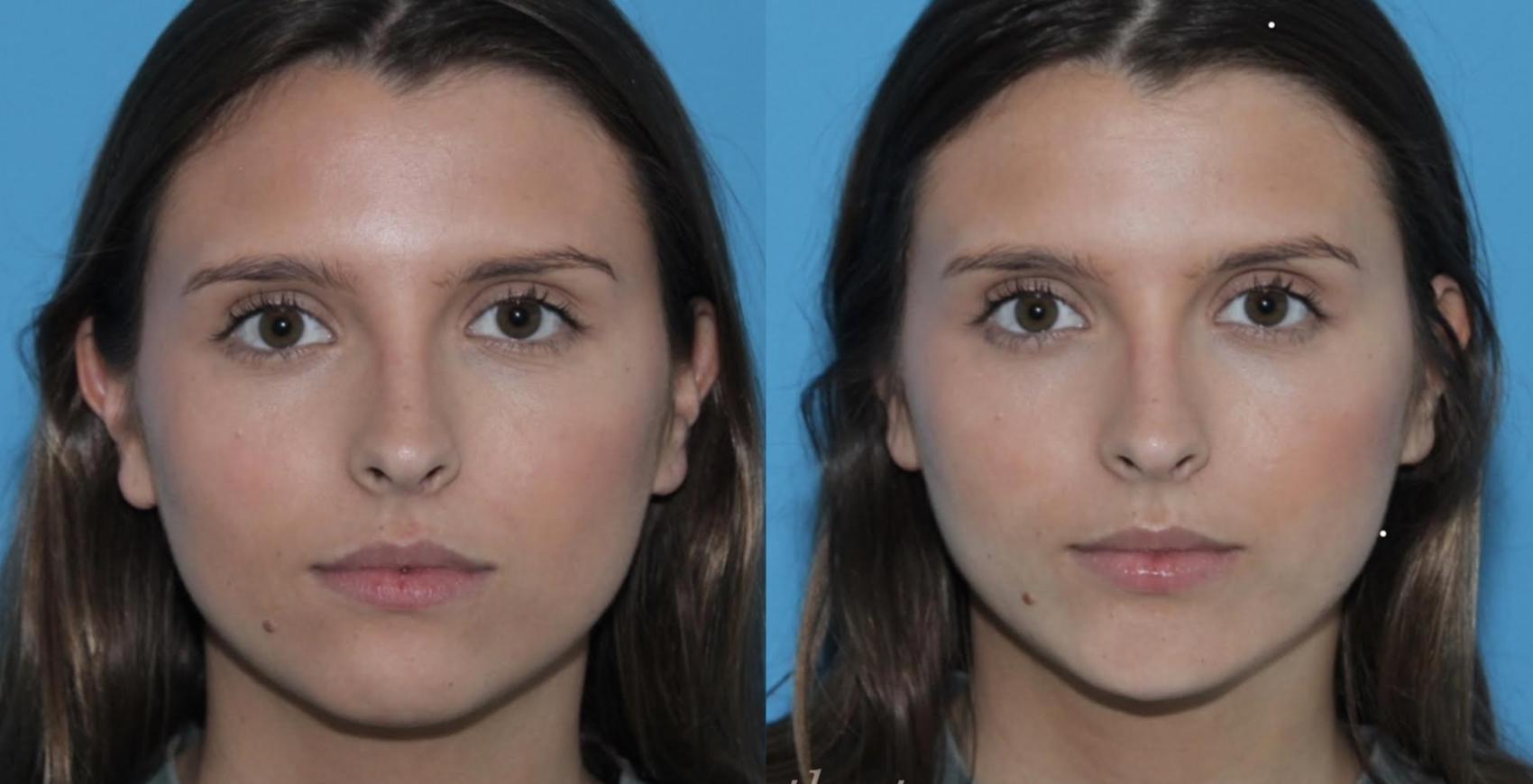 Subtle chin filler for pretty facial elongation + balancing by Ashlie Walsh, PA-C