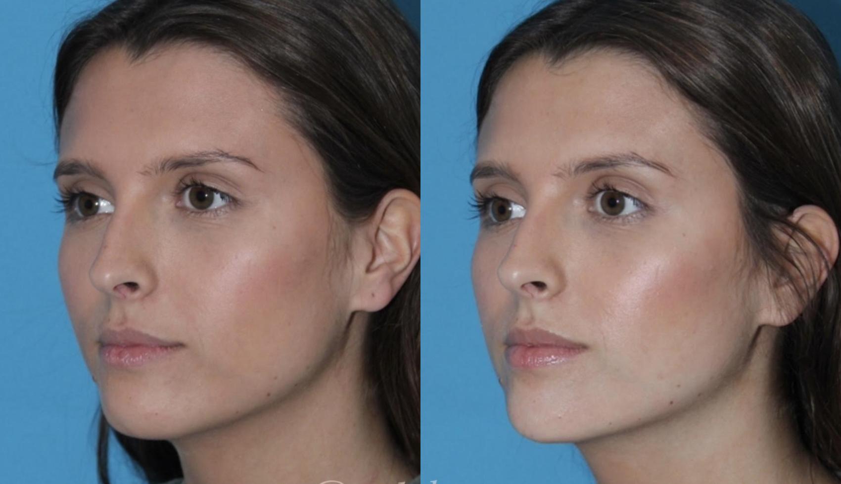 Subtle chin filler for pretty facial elongation + balancing by Ashlie Walsh, PA-C