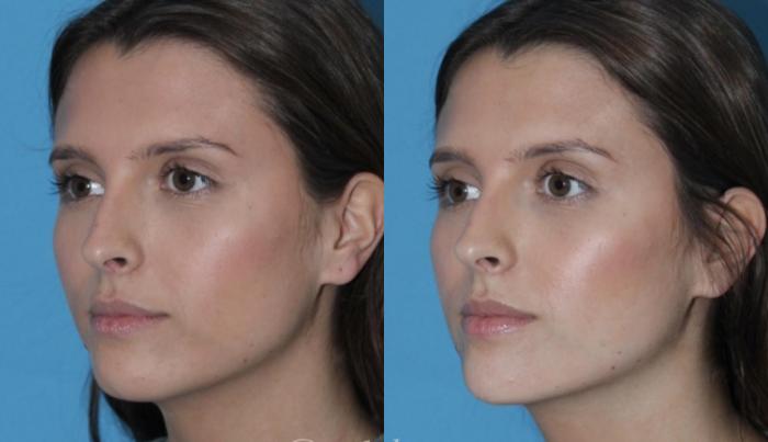 Subtle chin filler for pretty facial elongation + balancing by Ashlie Walsh, PA-C