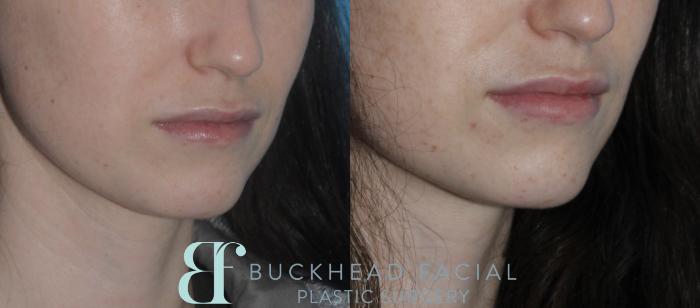 Subtle lip filler by Ashlie Walsh, PA-C