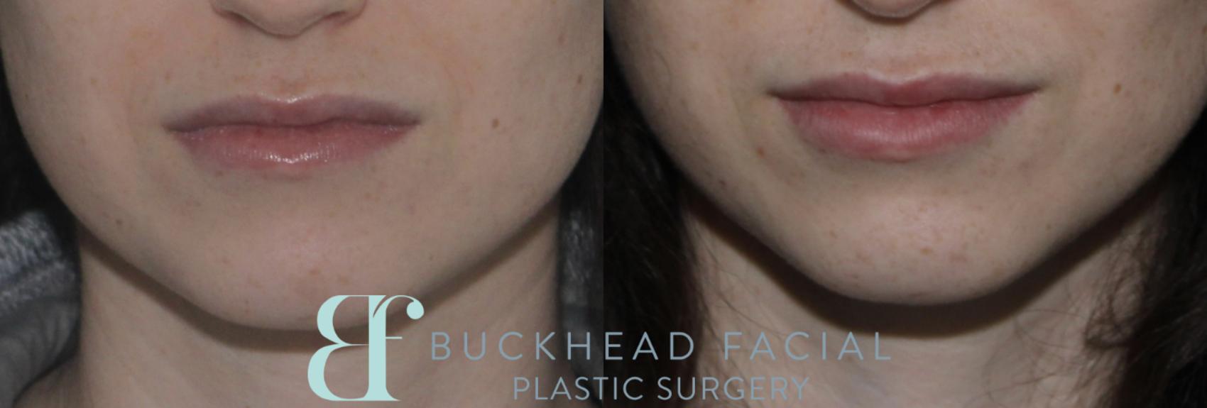 Subtle lip filler by Ashlie Walsh, PA-C