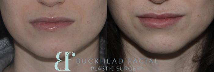 Subtle lip filler by Ashlie Walsh, PA-C