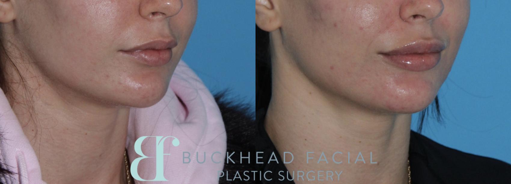 Beautiful lip filler by Ashlie Walsh, PA-C
