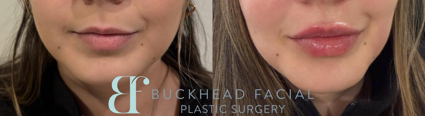 Lip filler in a patient who requested volume and vertical height, performed by Ashlie Walsh, PA-C