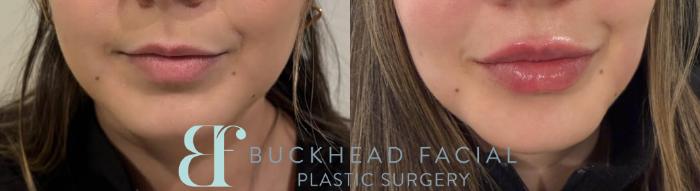 Lip filler in a patient who requested volume and vertical height, performed by Ashlie Walsh, PA-C