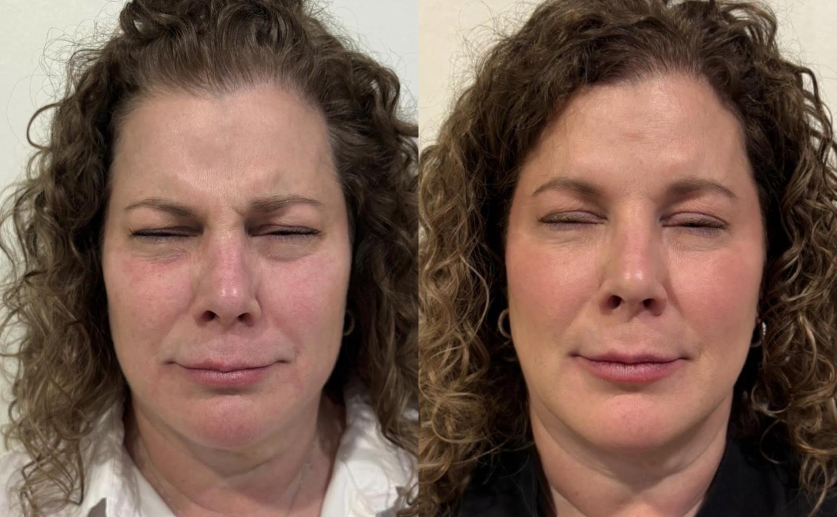 Before and after full-face Dysport and subtle filler for facial balancing by Ashlie Walsh, PA-C