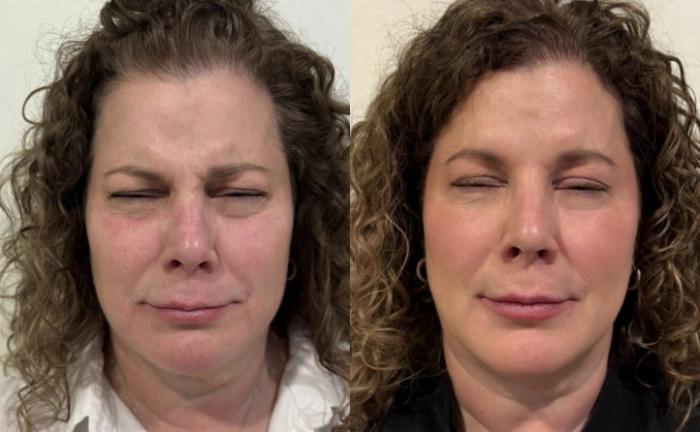 Before and after full-face Dysport and subtle filler for facial balancing by Ashlie Walsh, PA-C