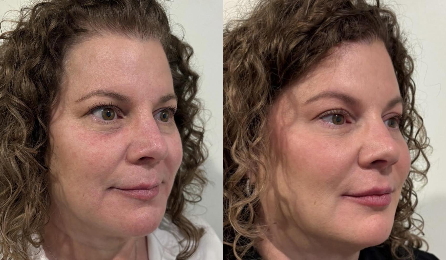 Before and after full-face Dysport and subtle filler for facial balancing by Ashlie Walsh, PA-C