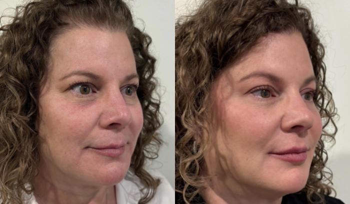 Before and after full-face Dysport and subtle filler for facial balancing by Ashlie Walsh, PA-C