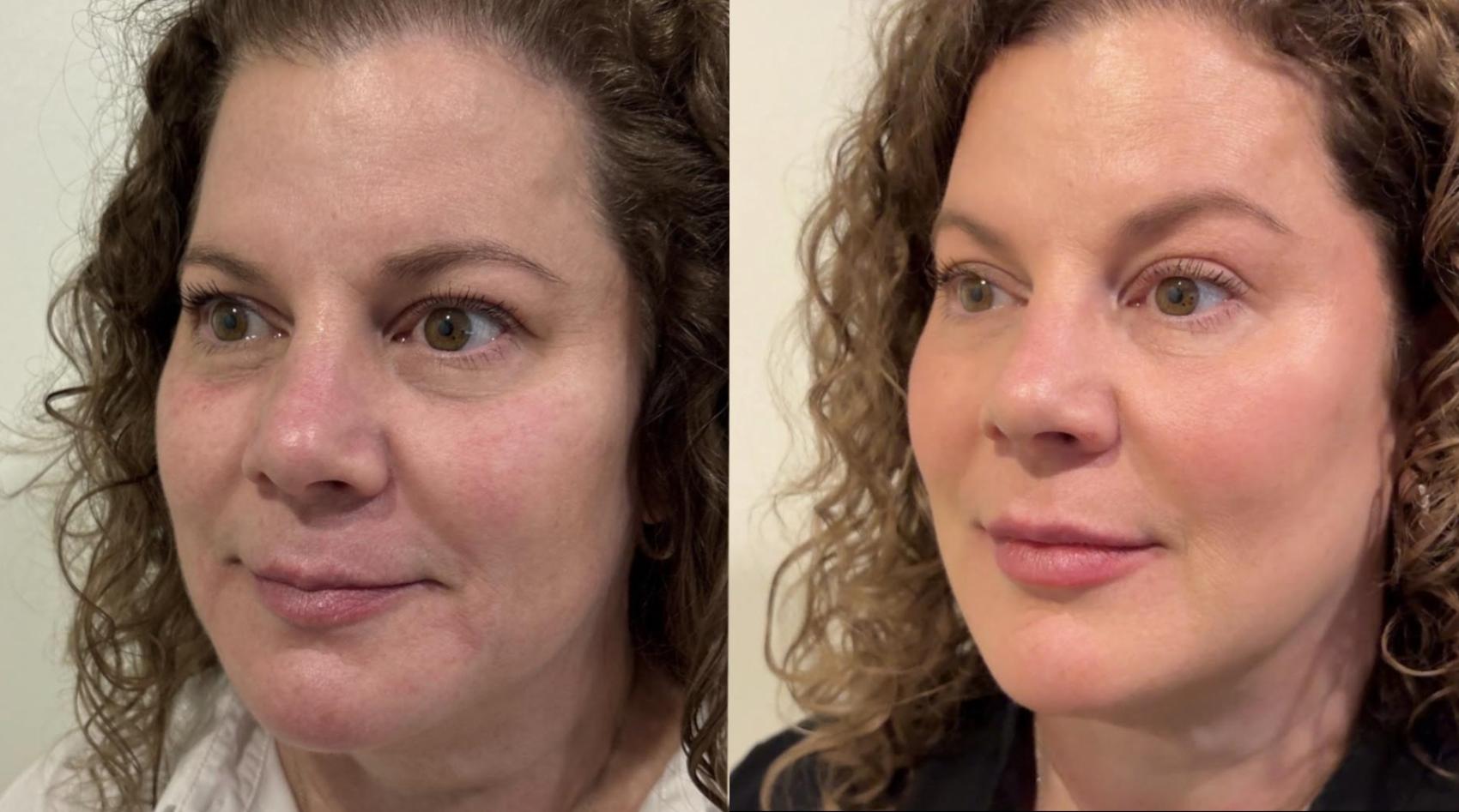 Before and after full-face Dysport and subtle filler for facial balancing by Ashlie Walsh, PA-C