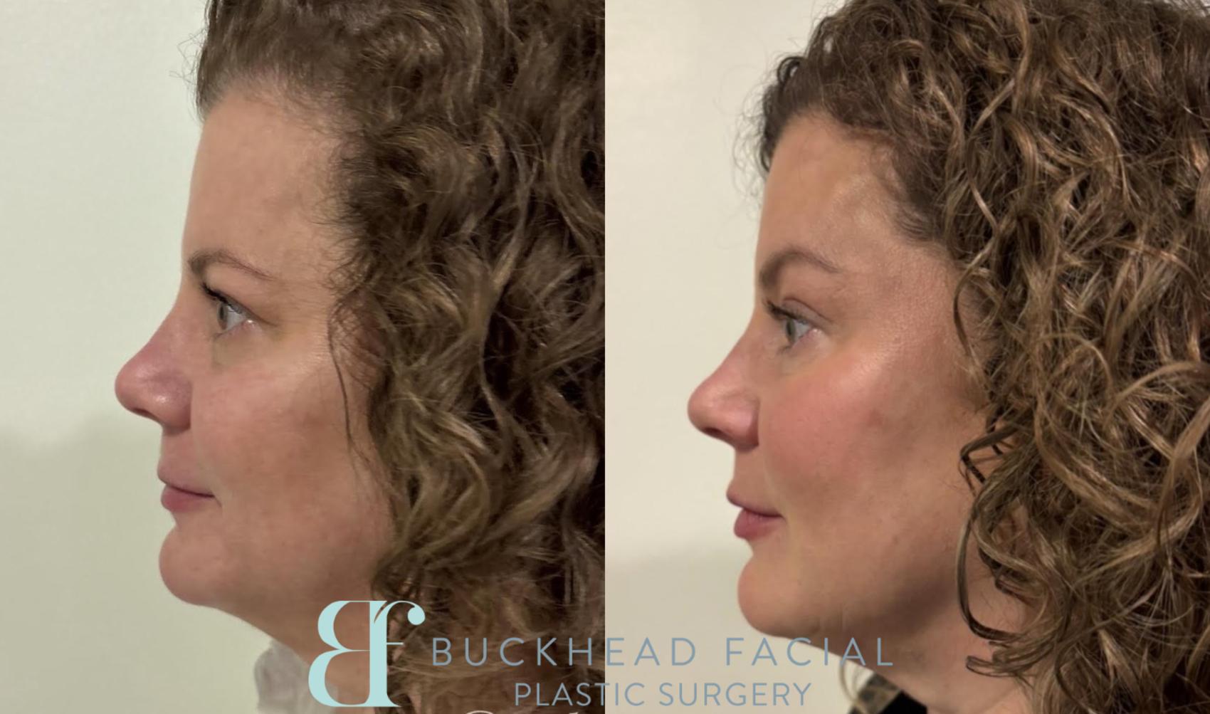 Before and after full-face Dysport and subtle filler for facial balancing by Ashlie Walsh, PA-C