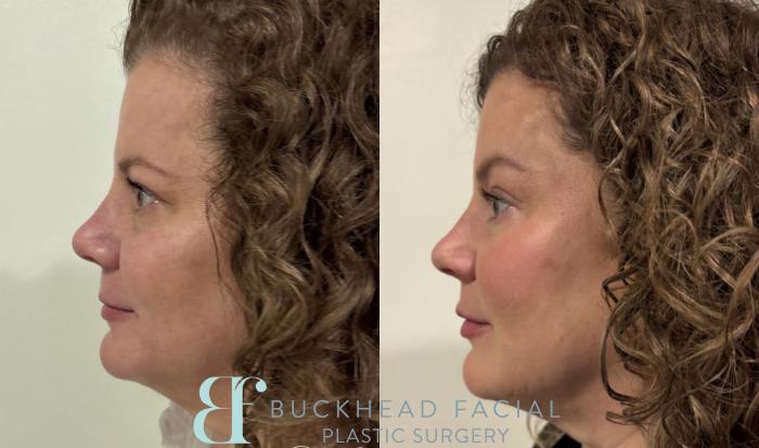 Before and after full-face Dysport and subtle filler for facial balancing by Ashlie Walsh, PA-C