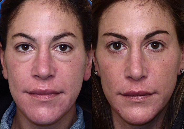 Before & After Eyelid Surgery (Blepharoplasty) Case 4 View #1 View in Atlanta, Georgia