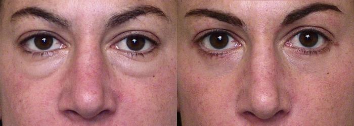Before & After Eyelid Surgery (Blepharoplasty) Case 4 View #3 View in Atlanta, Georgia