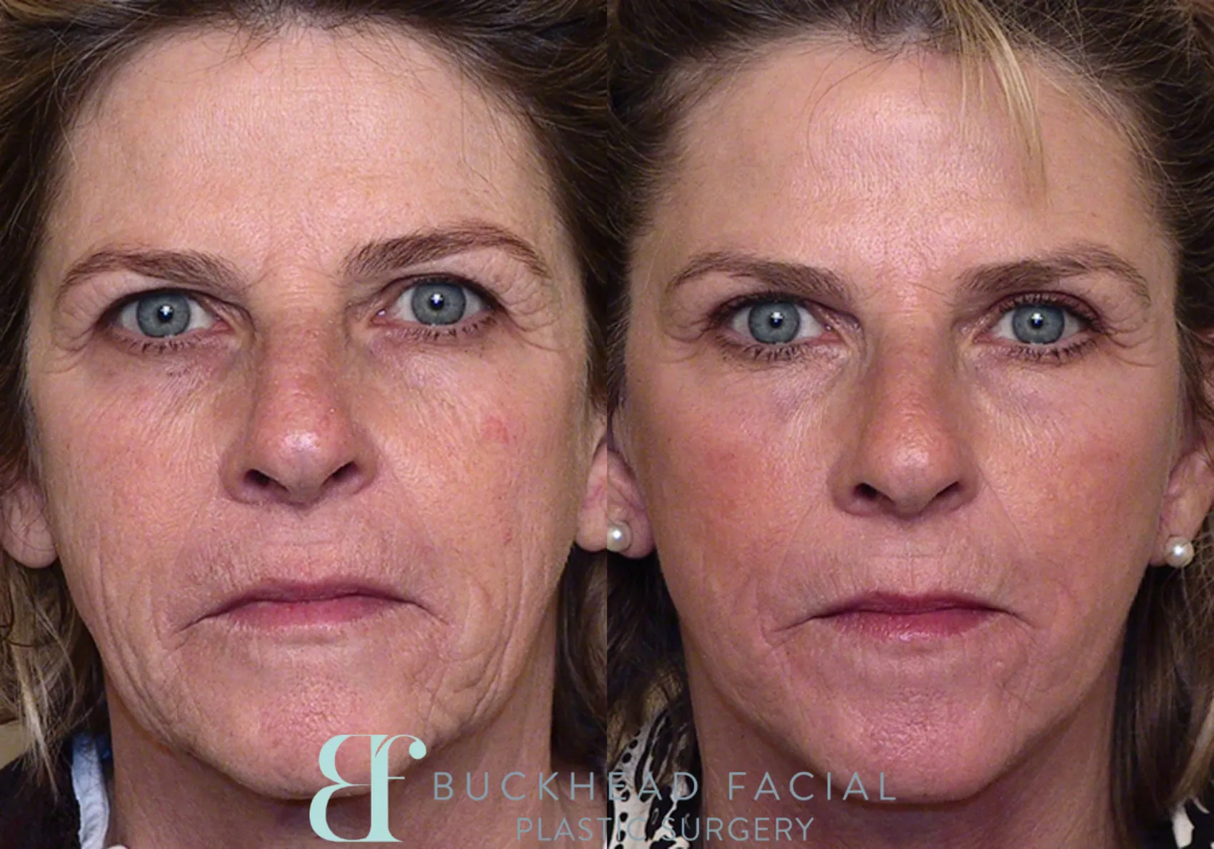Facelift Before and After Pictures Case 7 | Atlanta, Georgia Facelift Before and After Pictures Case 7 | Atlanta, Georgia