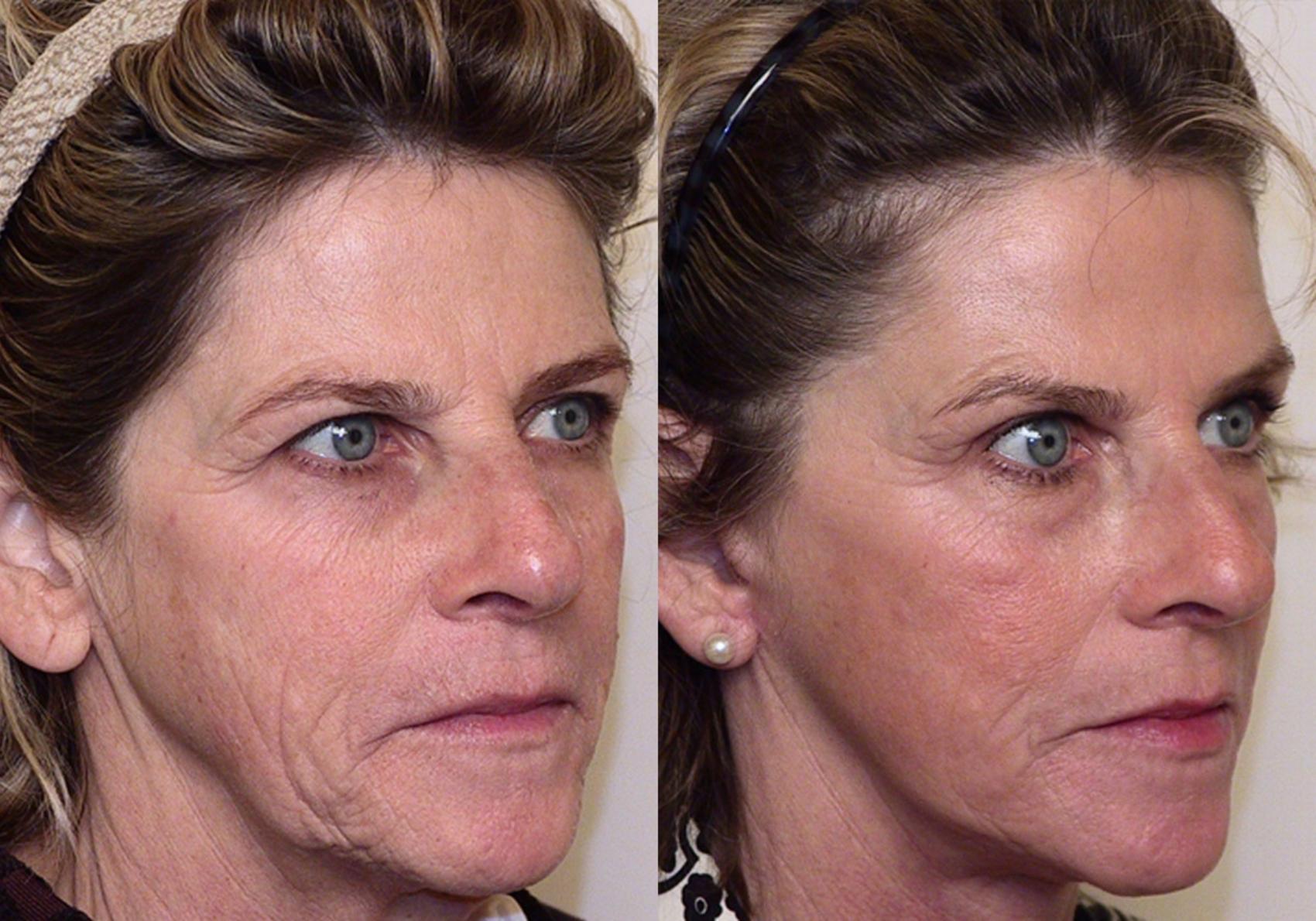 Facelift Before And After Pictures Case 7 Atlanta Georgia Buckhead Facial Plastic Surgery 0822