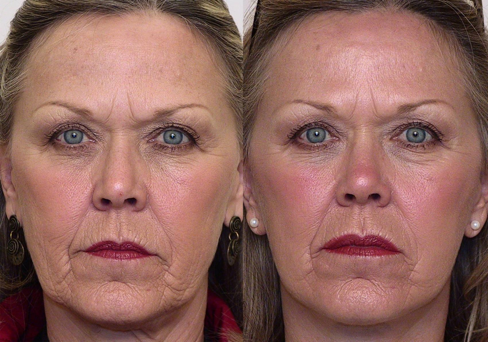 Natural Looking Face and Neck Lift Results A natural looking face and neck  lift result is one where there are no obvious or telling signs that any  'work' has been done.