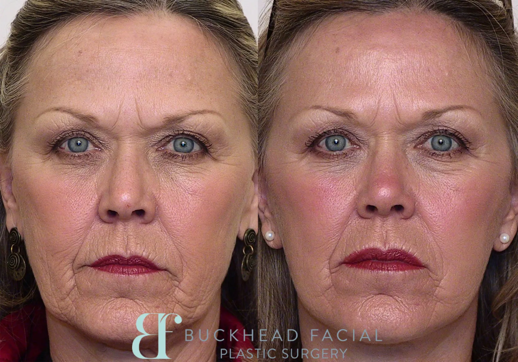 facelift-9-view-1-detail.webp