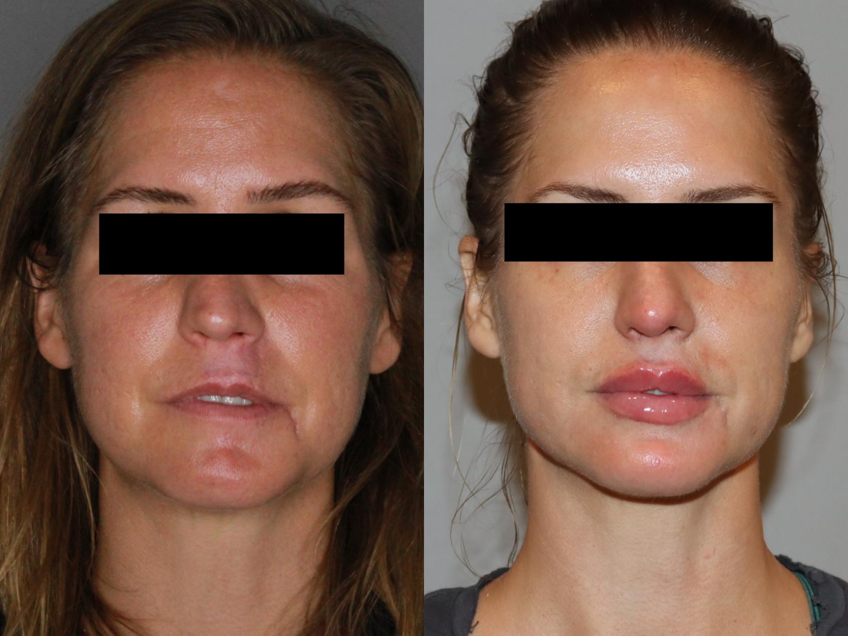 Before & After Facial Rejuvenation Case 147 Front View in Atlanta, Georgia