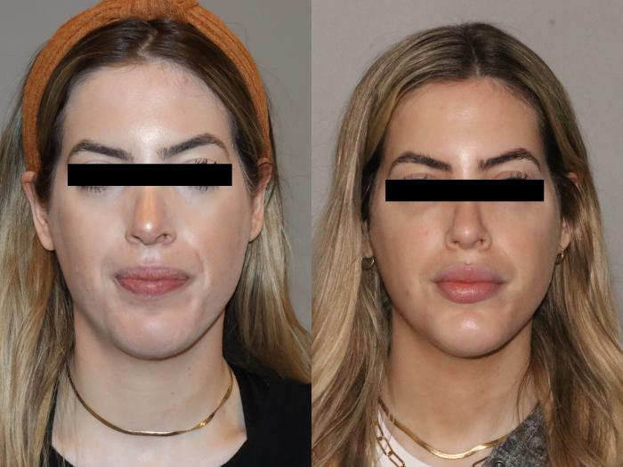 Before & After Facial Rejuvenation Case 149 Front View in Atlanta, Georgia