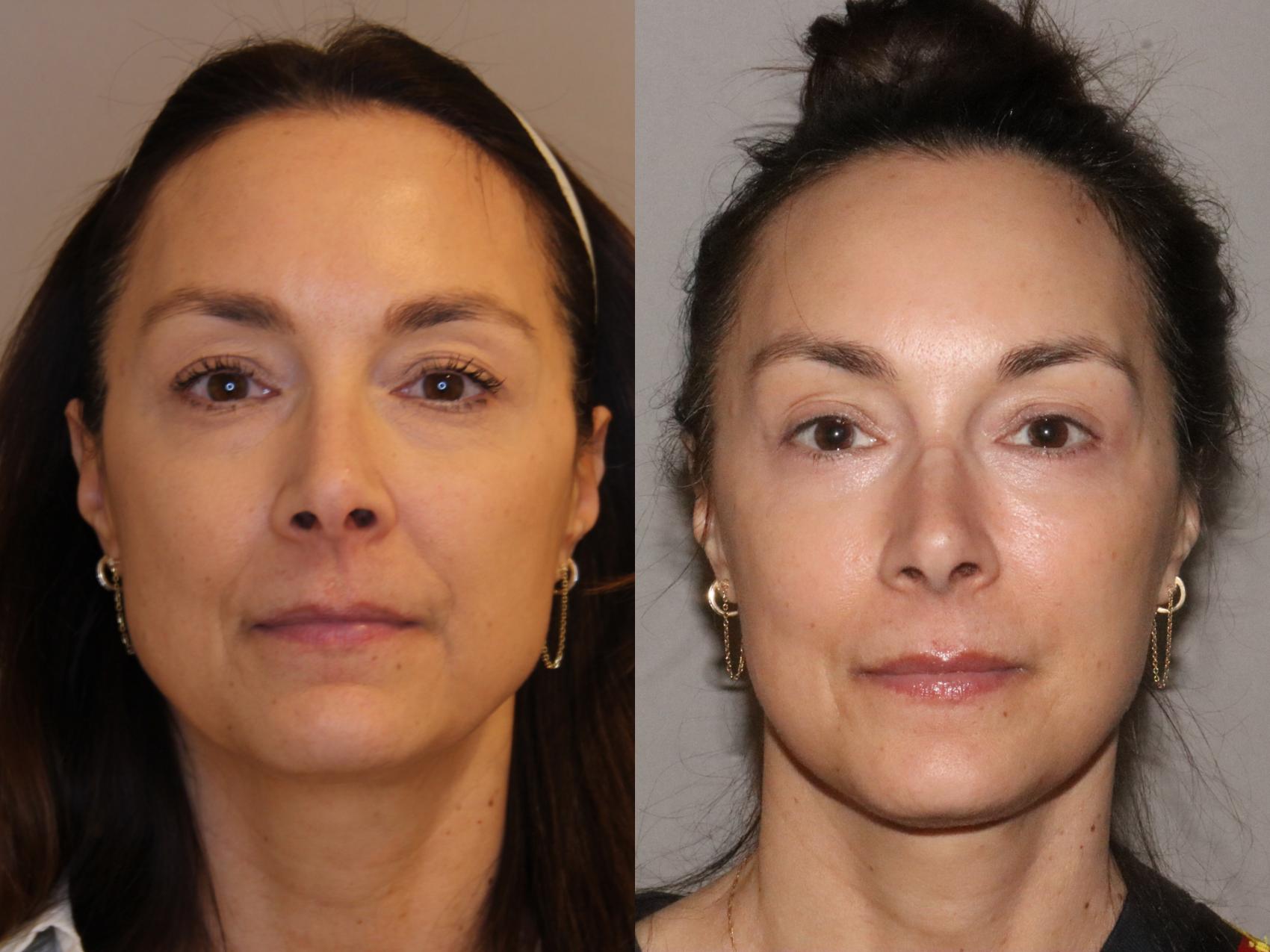 Before & After Facial Rejuvenation Case 164 Front View in Atlanta, Georgia