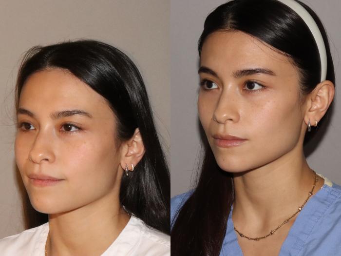 Before & After Facial Rejuvenation Case 166 Left Oblique View in Atlanta, Georgia