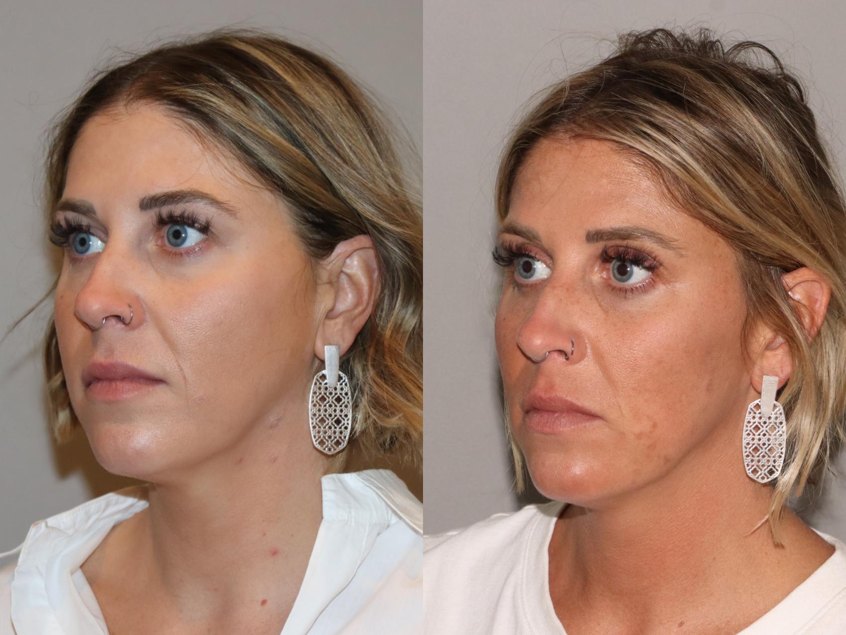 Before & After Facial Rejuvenation Case 168 Left Oblique View in Atlanta, Georgia