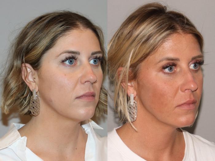Before & After Facial Rejuvenation Case 168 Right Oblique View in Atlanta, Georgia