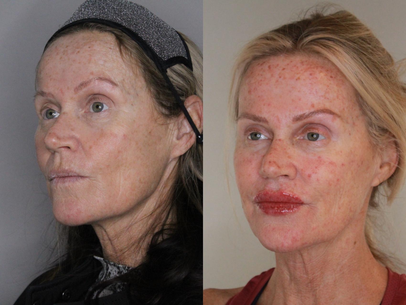 Before & After Facial Rejuvenation Case 169 Left Oblique View in Atlanta, Georgia