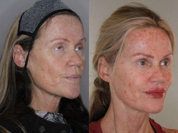 Before & After Facial Rejuvenation Case 169 Right Oblique View in Atlanta, Georgia