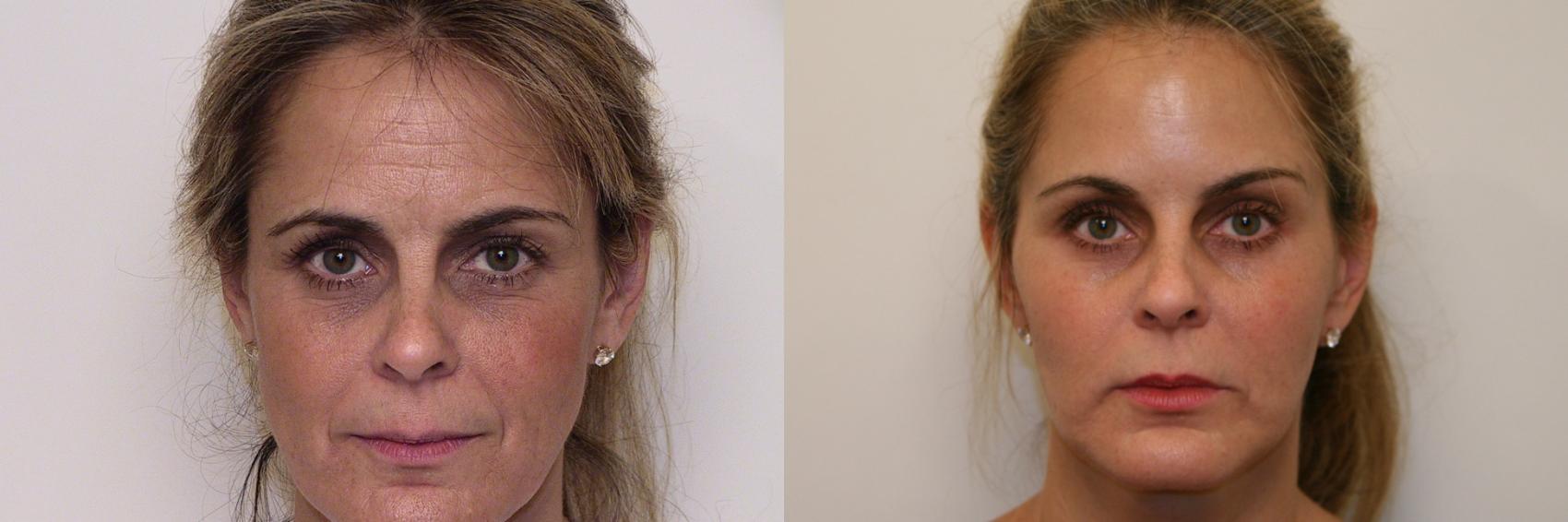 Best Natural Facelift Atlanta, GA