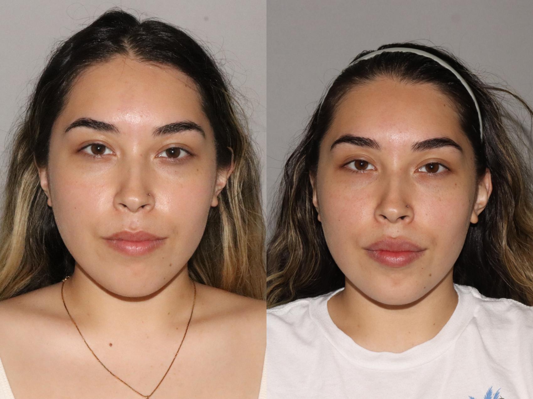 Before & After Facial Rejuvenation Case 170 Front View in Atlanta, Georgia