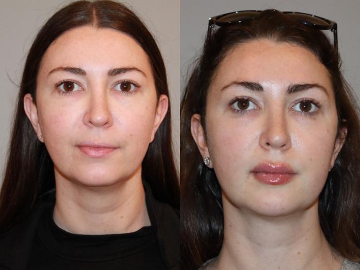 Before & After Restylane LYFT Case 173 Front View in Atlanta, Georgia