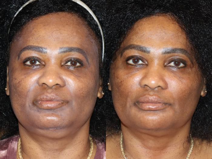 Before & After Facial Rejuvenation Case 174 Front View in Atlanta, Georgia